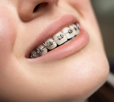5 REASONS WHY NOT TO GET BRACES!!