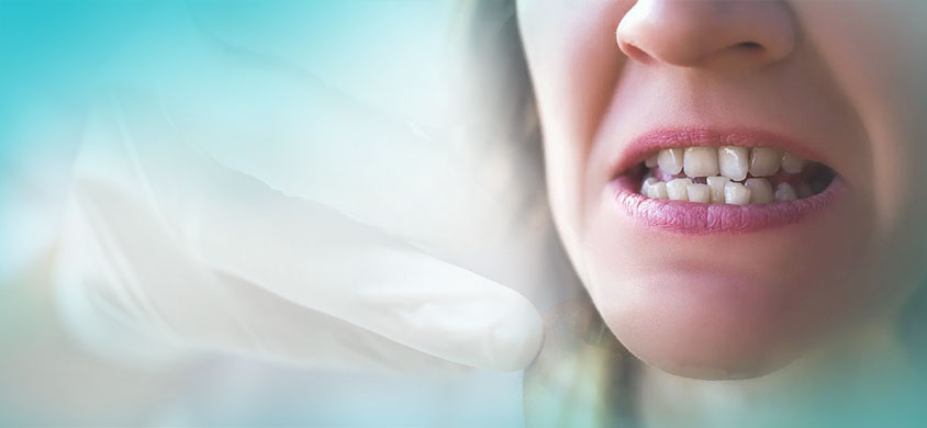 Why teeth aligners are best to treat misalignment?